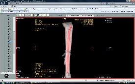 Tibia Kırıkları