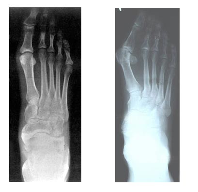 Hallux Valgus