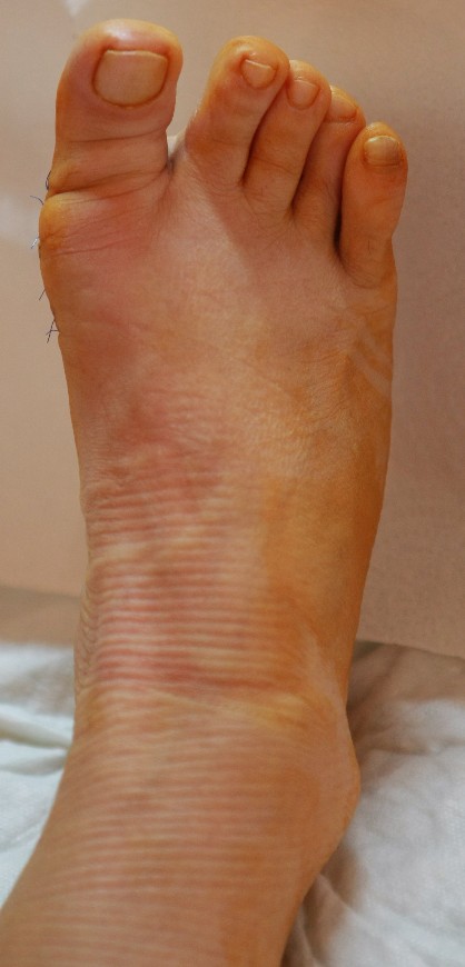 Halluks Valgus — görsel 3