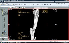 Tibia Kırıkları