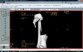 Femur Kırıkları