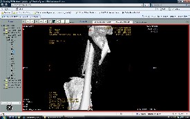 Femur Kırıkları