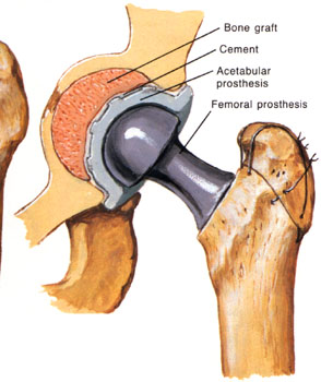Femur Kırıkları