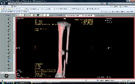 Tibia Kırıkları