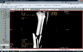 Tibia Kırıkları