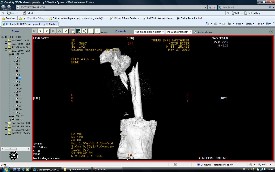 Femur Kırıkları