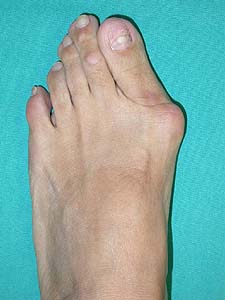 Hallux Valgus