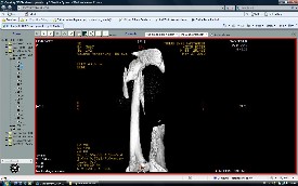 Femur Kırıkları
