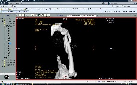 Femur Kırıkları