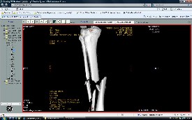 Tibia Kırıkları