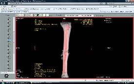 Tibia Kırıkları