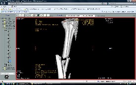 Tibia Kırıkları