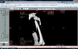 Femur Kırıkları