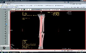 Tibia Kırıkları