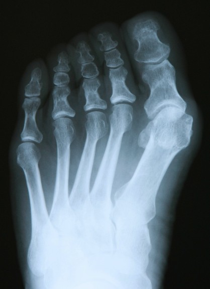 Hallux Valgus