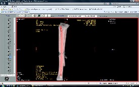 Tibia Kırıkları