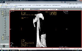 Femur Kırıkları