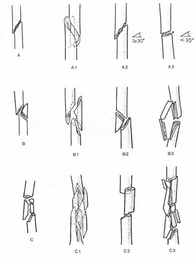 FEMUR KIRIKLARI image 3
