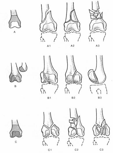 FEMUR KIRIKLARI image 4